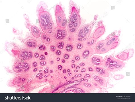 Squamous Papilloma On Tongue