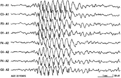 3 Hz Spike Waves In The Interictal Eeg A Test Word Presented During