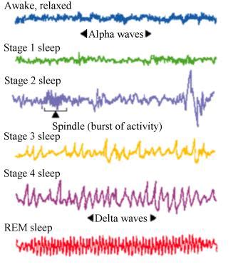 EEG Reading Showing Different Stages Of Sleep