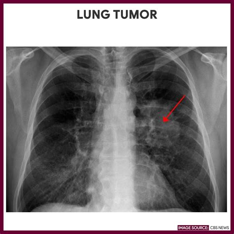 Chest X Ray Chest Radiography Nursing Responsibilities Nurseslabs