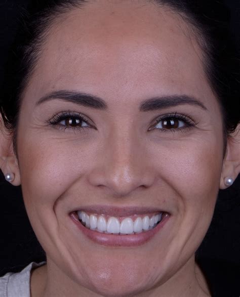 Porcelain Veneers Mission Valley San Diego Ca