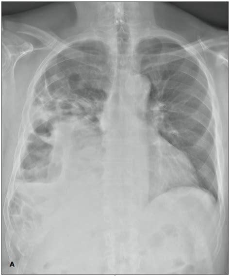 Diaphragmatic Hernia | Consultant360