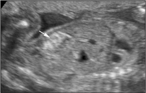 Prenatal Sonographic Diagnosis Of Meconium Periorchitis Wax 2007