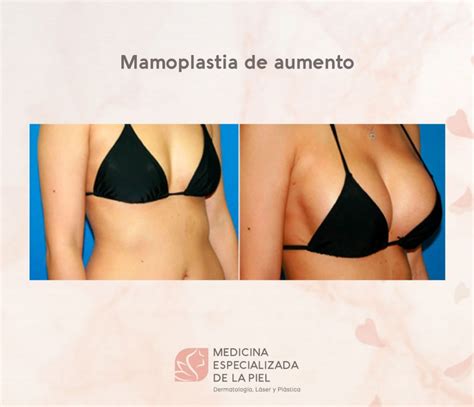 Mamoplastia De Aumento Medicina Especializada En La Piel