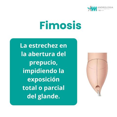 Tratamiento De La Fimosis Sin Bisturí Am