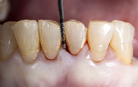 What Is Periodontitis