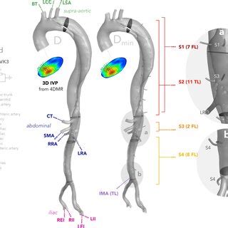 A comparison of mean and maximum transmural pressure (TMP) along the ...