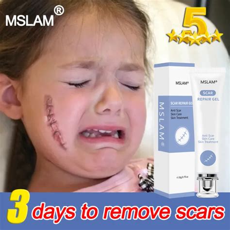 Days Recovery Mslam Peklat Remover Cream Burn Scar Repair Acne Cream