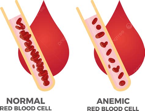 Anemia Hierro Glóbulos Rojos Medical Vector Ilustración Png Anemia Sangre Célula Png Y