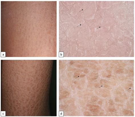 Common Forms Of Inherited Ichthyoses Ichthyosis Vulgaris Is