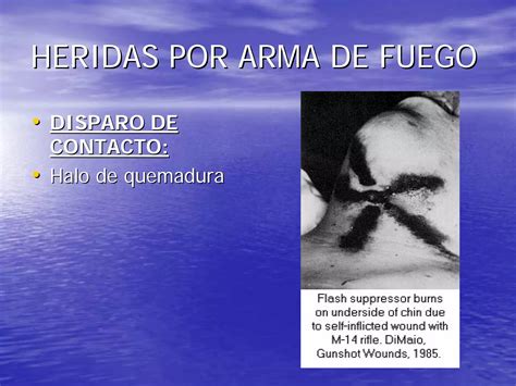 Heridas Por Arma De Fuego Ppt