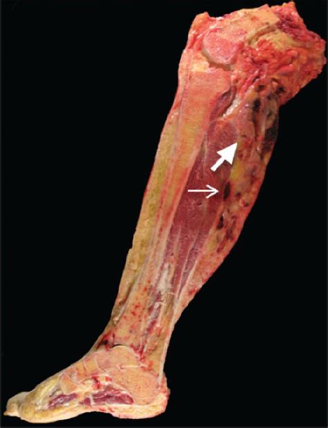 Giant Cell Tumor On Foot Discount Emergencydentistry