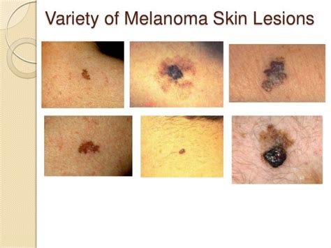 melanoma stages pictures - pictures, photos