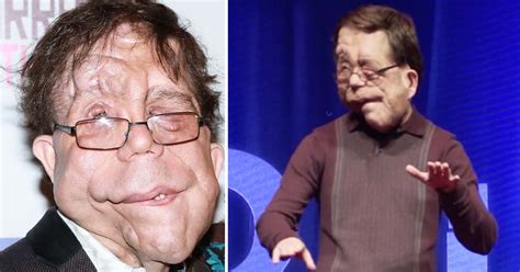 The Incredible Story Of Adam Pearson He Became A Movie Star Despite