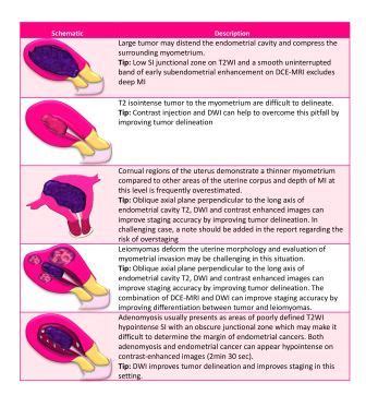 Guidelines from ESUR: endometrial cancer - European Radiology