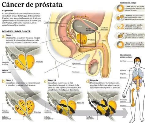 El PSA antes de los 55 años no aporta beneficios en la detección del