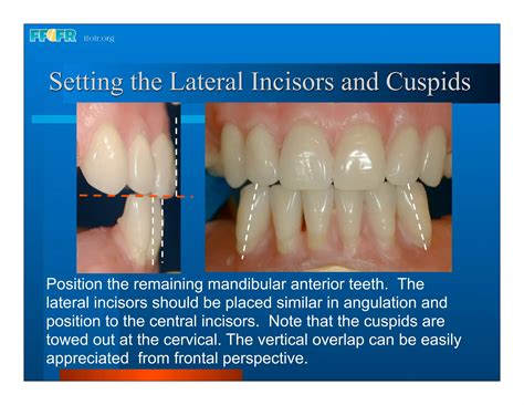 Complete Dentures 16occlusal Schemes Lingualized Occlusion Ppt