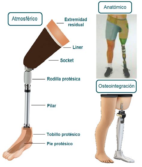 Creta Oyente Art Culo Protesis Para Desarticulacion De Rodilla