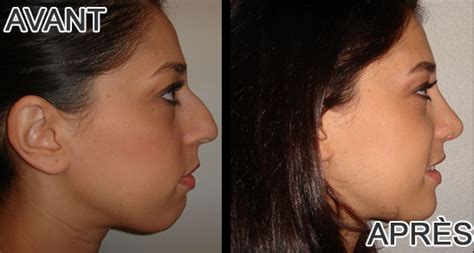 Rhinoplastie Avant Apr S Rhinoplastie Nice Chirurgien Cannes Nice