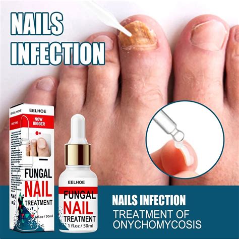 Nail Fungus Treatment Cream Onychomycosis Paronychia Anti Fungal Herbal