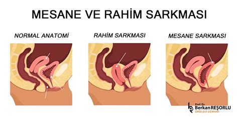 Mesane ve Rahim Sarkması Prof Dr Berkan Reşorlu