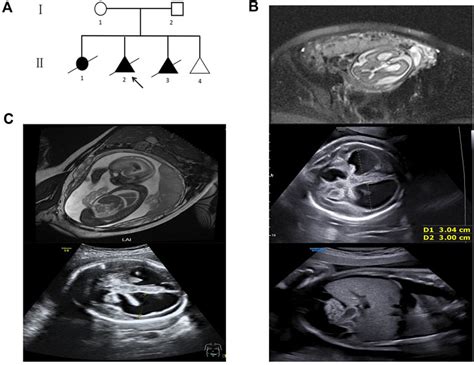 Frontiers Case Report Prenatal Diagnosis Of Fetal Off