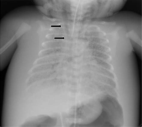 -Preoperative chest X-ray image showing pneumomediastinum (black ...