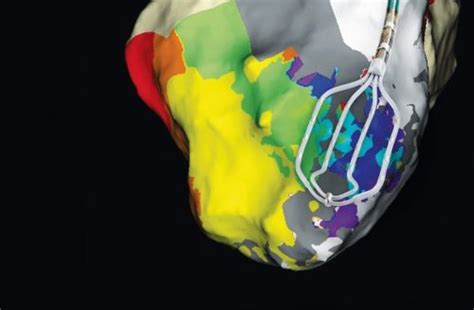 The Advisor HD Grid Mapping Catheter Sensor Enabled Maps At High