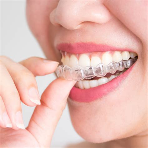 Hidden Braces Blackburn Orthodontics Orthodontics