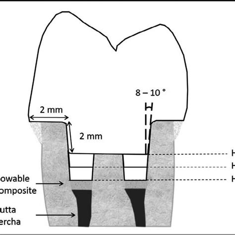 Diagram of the three types of preparations. Intracoronal height of the ... 