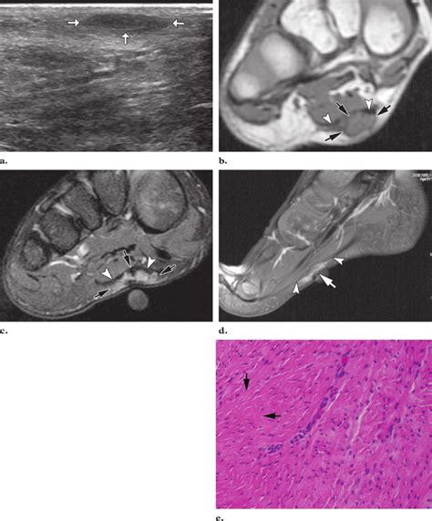 Plantar Fibromatosis In A 6 Year Old Girl With A Palpable Mass Along Download Scientific