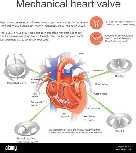 Mechanical Heart Valve