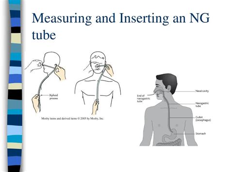 Ppt Nasogastric And Gastrointestinal Intubations Powerpoint