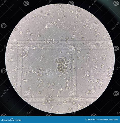 Célula Bacteriana Fresca En Muestra De Orina Imagen de archivo Imagen