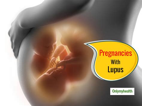 Tips For Living With Lupus While Pregnant Onlymyhealth