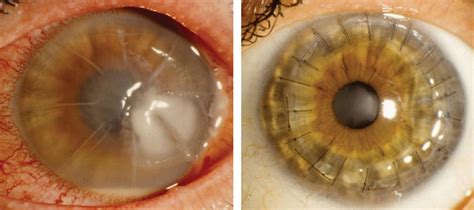 Cornea Surgery Outcomes Mass Eye And Ear