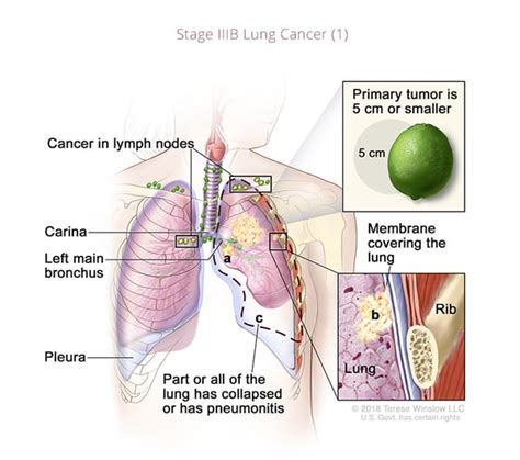 Stages Of Lung Cancer Diagram