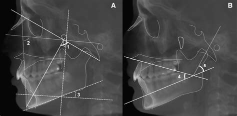 The Relationship Of Articular Eminence And Mandibular Fossa Morphology To Facial Profile And