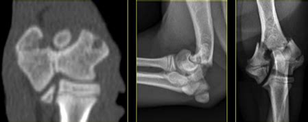 Msk Final Articular Fractures Flashcards Quizlet