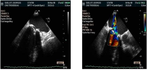 Preoperative Transesophageal Two Dimensions Echocardiography And Download Scientific Diagram