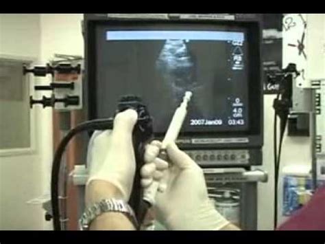 Endobronchial Ultrasound Ebus Biopsy Of Mediastinal Lymph Nodes