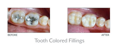 Tooth Colored Fillings - Crest Dental of Valencia