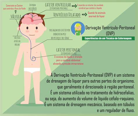 Deriva O Ventr Culo Peritoneal Dvp Enfermagem Ilustrada Tecnico