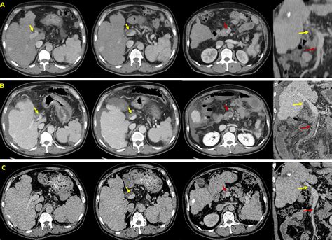 Frontiers Case Report Rapid Development Of Acute Symptomatic Portal