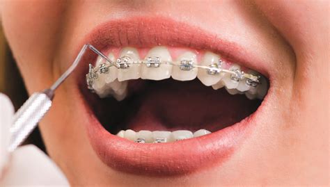 Fixed Braces Stafford Metal Braces Stella Dental Off