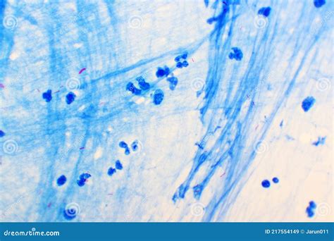 Mycobacterium Tuberculosis Positive Small Red Rod In Sputum Smear Stock