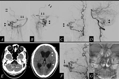 Digital Subtraction Angiography Dsa Shows A Dural Arteriovenous