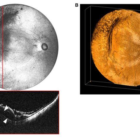 A Widefield En Face Oct Image Of A Stage A Tractional Retinal