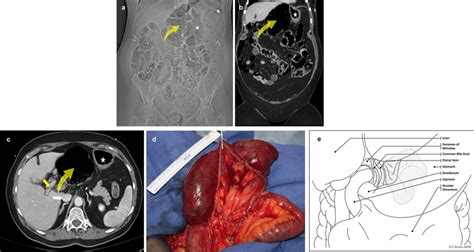 a–e 69-year-old female with epigastric pain and foramen of Winslow ...