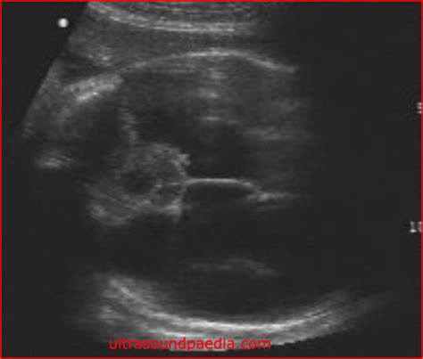 Hydranencephaly Ultrasound